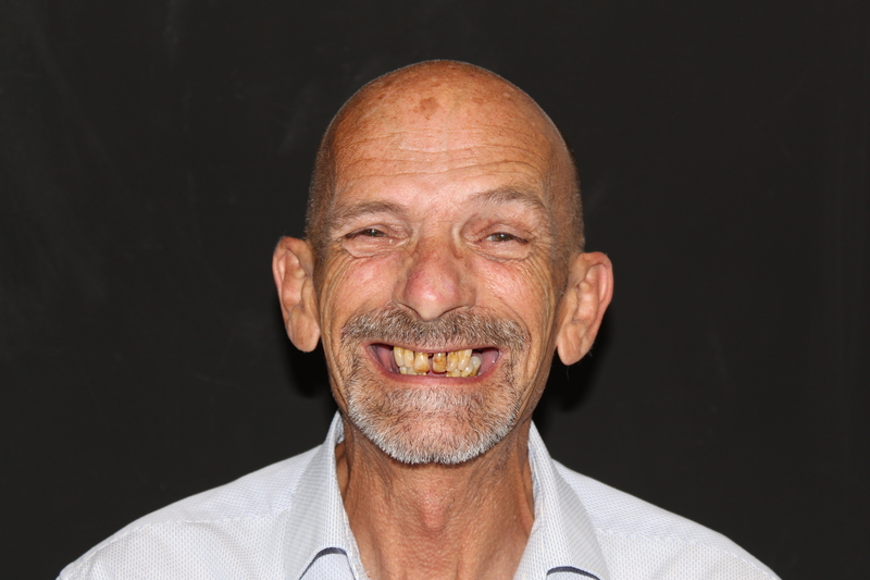 Patient 1 before dental implants