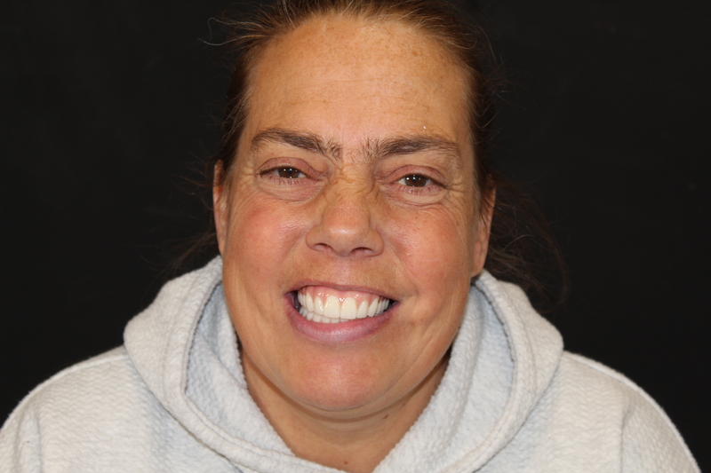 Patient 2 after New Life Teeth Zirconia implants