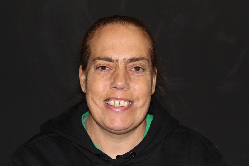 Patient 2 before dental implants
