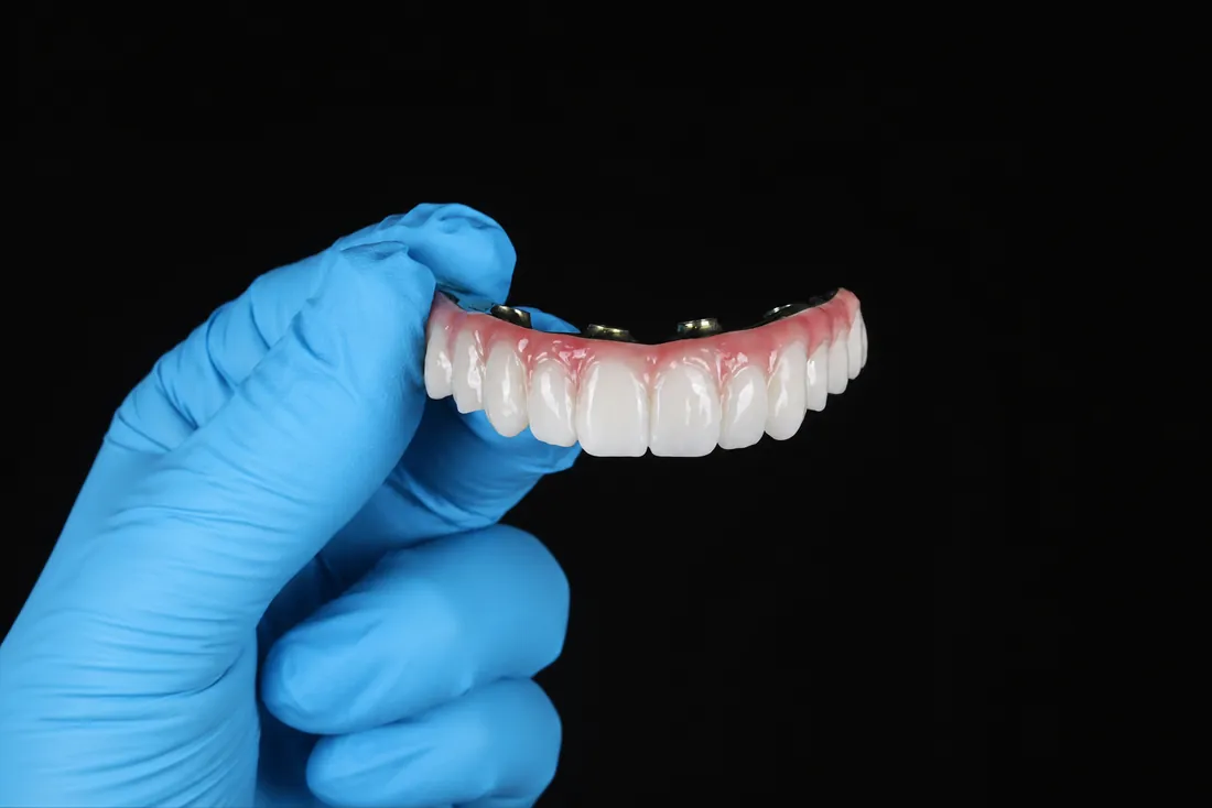 Prettau Zirconia Teeth Forever bridge held against a black background, showing the lifelike teeth and titanium implant fixtures